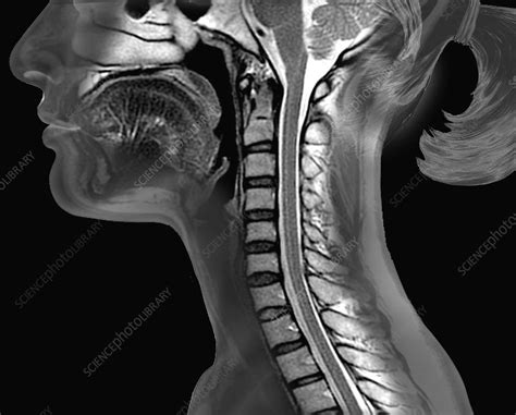 Cervical MRI scan .